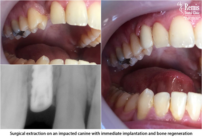 Implants - Same Day Teeth 1