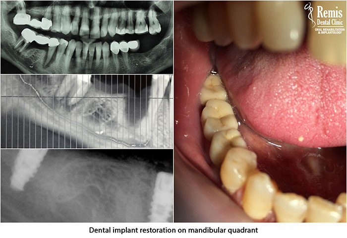 Implants - Same Day Teeth 6