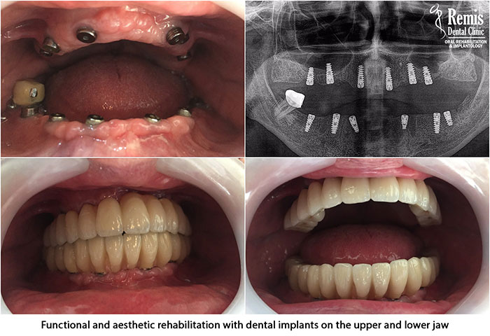 Implants - Same Day Teeth 7